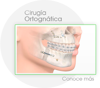 Cirugía Ortognática, Ortognática Perú, Maxilofacial, Maxilofacial Perú, Mentoplastía, estética perú, bolas de Bichat, prognatismo mandibular