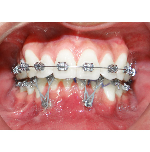 miniimplantes, microimplantes, microtornillos, TAD’s, ortodoncia rapida, ortodoncia acelerada, ortodoncia, ortodoncia peru, solucion dental, miniimplantes, microimplantes, microtornillos, TAD’s, ortodoncia rapida, ortodoncia acelerada, ortodoncia, ortodoncia peru, solucion dental,