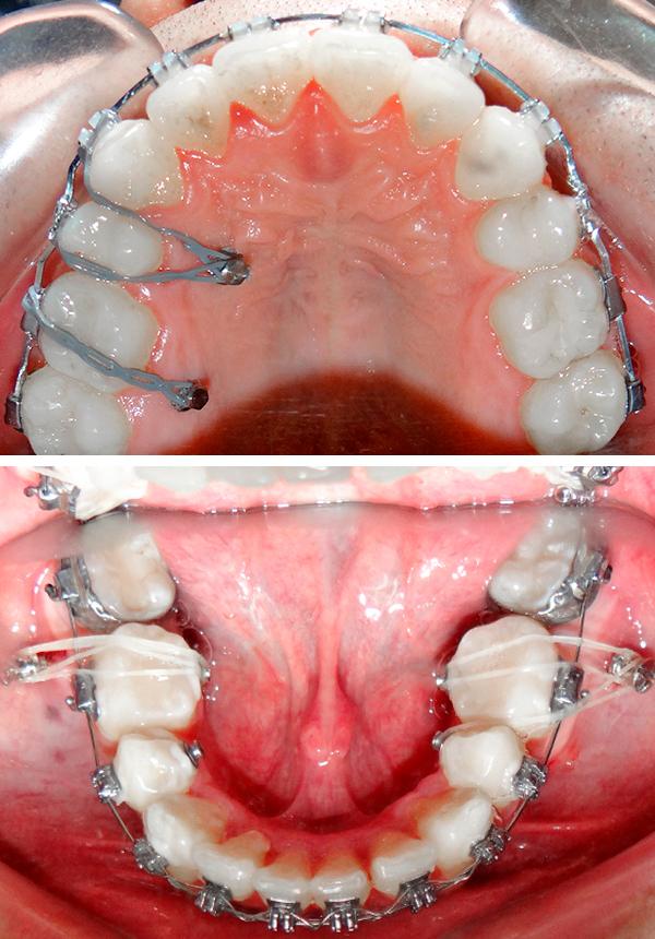 mover dientes, bandas, micro implantes, brackets autoligables, brackets esteticos, brackets de zafiro , ortodoncia en lima, espelistas en ortodoncia, enderezamiento de molares, molares lingualizados, mover dientes, bandas, micro implantes, brackets autoligables, brackets esteticos, brackets de zafiro , ortodoncia en lima, espelistas en ortodoncia, enderezamiento de molares, molares lingualizados,